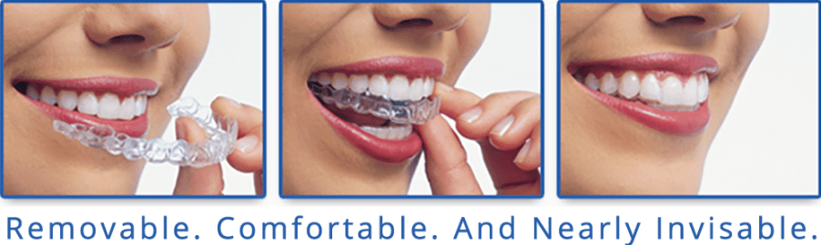 Invisalign Clear Braces, Sherwood Heights Dentist