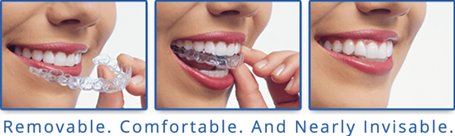 Invisalign® in Halifax  Parkland Dental in Halifax Invisalign®